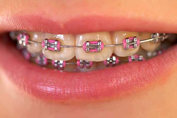 Invisalign