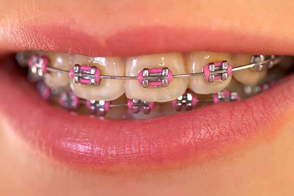 Metal Braces in Maplewood, NJ