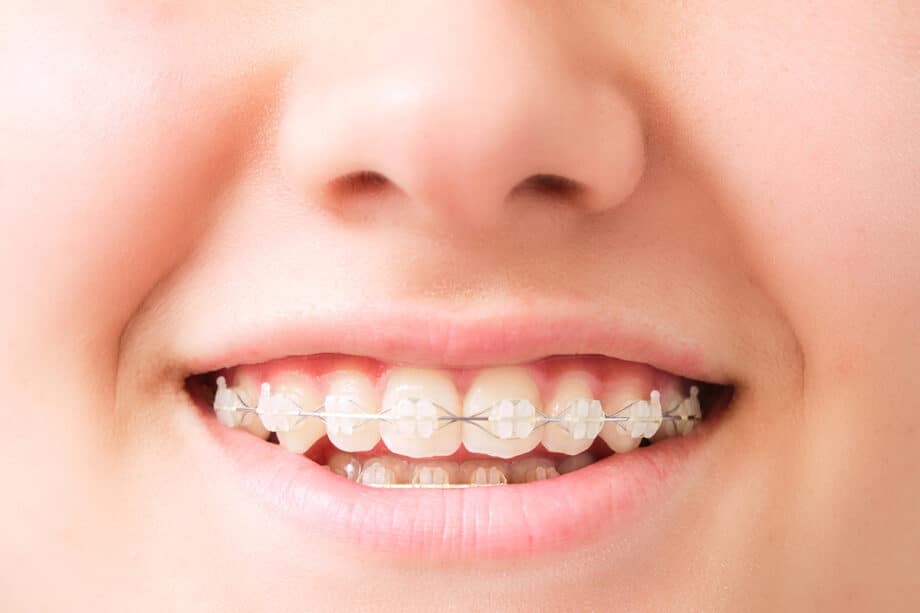 Can Clear Braces Correct the Same Problems as Metal Braces?