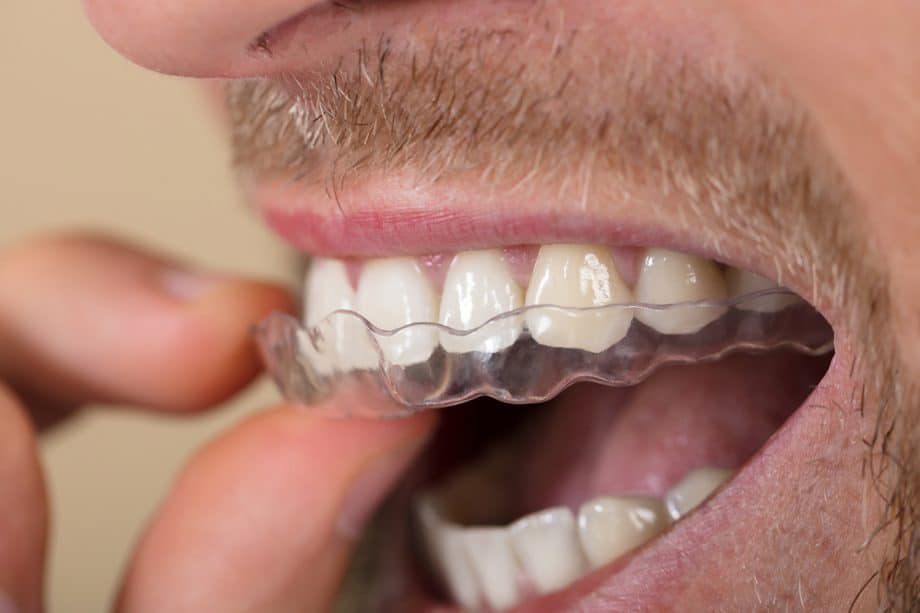How Long Does Invisalign Take For A Teen?